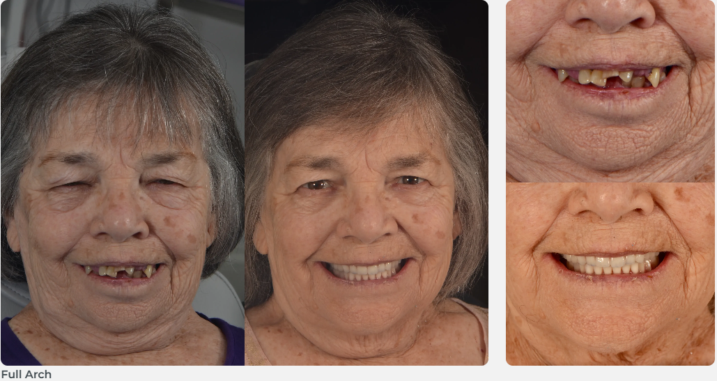 Patient dental result - Full Arch