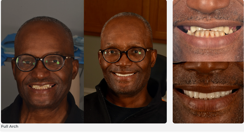 Patient dental result - Full Arch