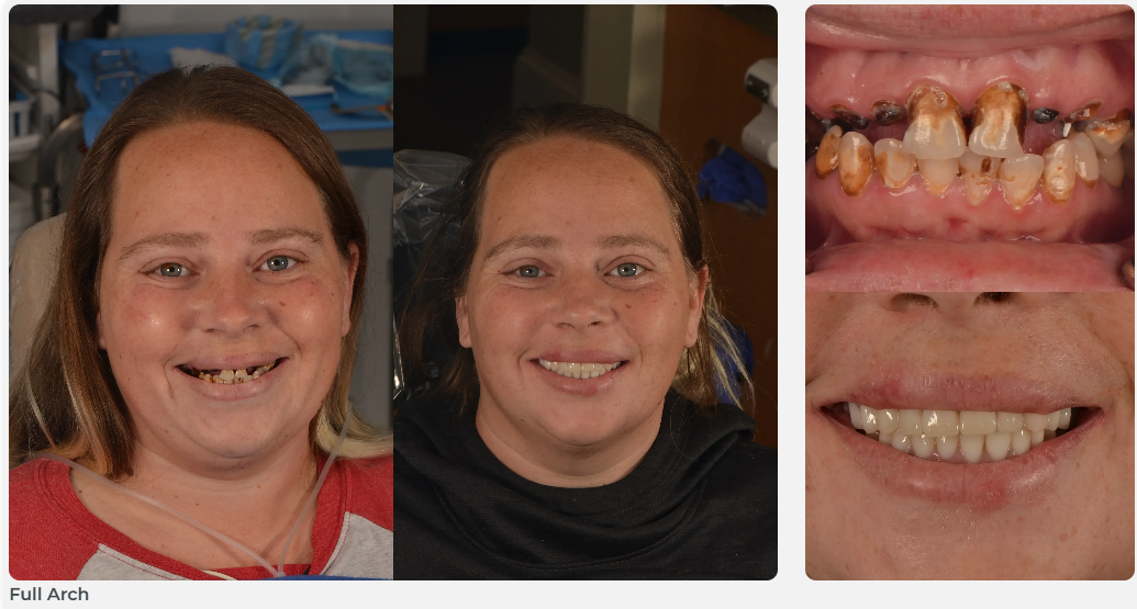Patient dental result - Full Arch